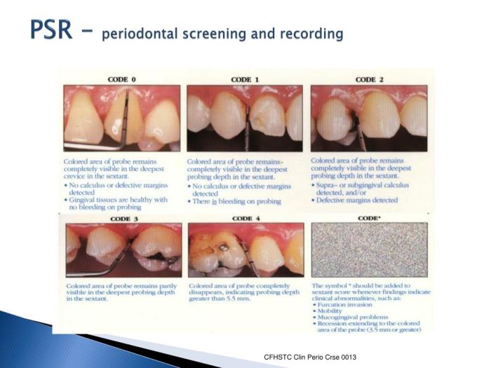 Periodontal screening and recording codes